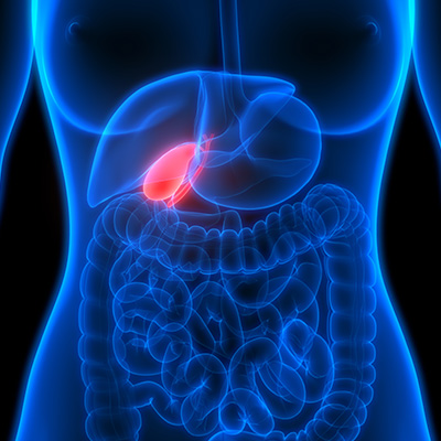 Gallstones in Gall Bladder