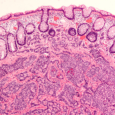 Neuroendocrine tumours